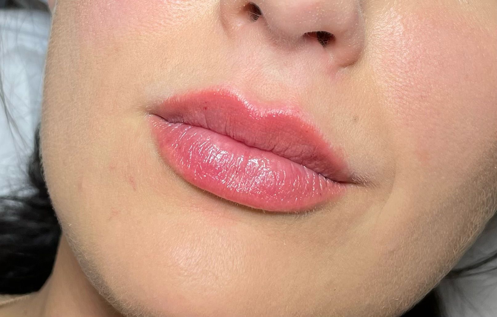 Lip Filler Treatments in London: Natural Lip Enhancement & Subtle Lip Augmentation