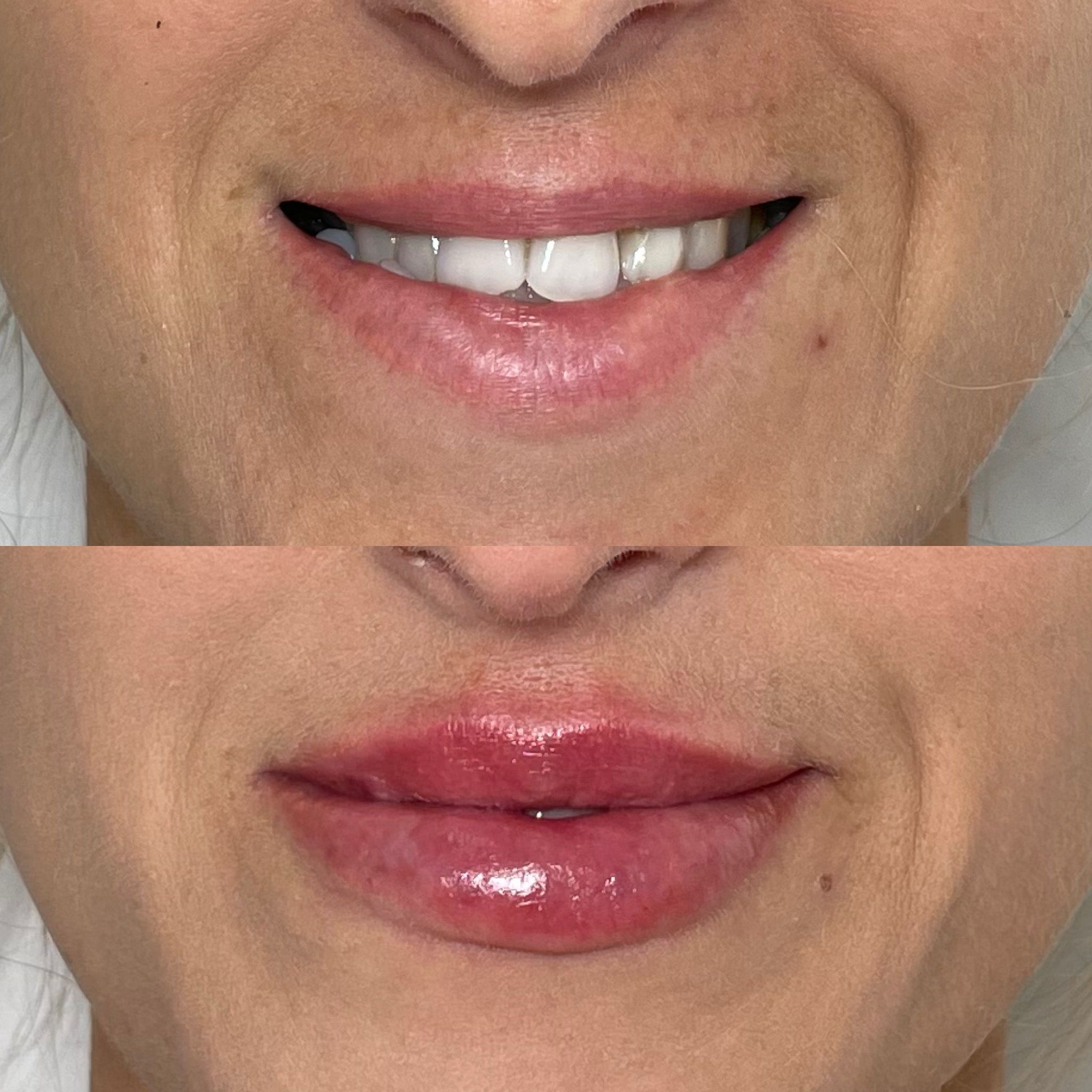 Lip Filler Treatments in London: Natural Lip Enhancement & Subtle Lip Augmentation